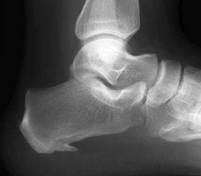 Röntgenbild eines Fußgelenks mit plantarem Fersensporn
